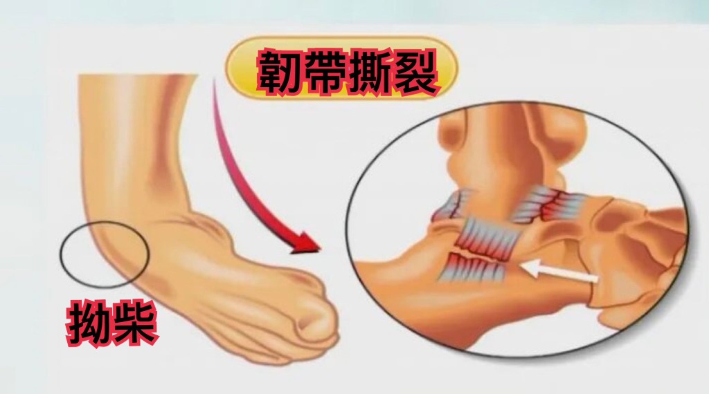慢性踝關節不穩定分為機械性和功能性。筆者提供圖片